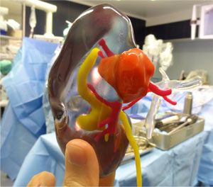 Using Stratasys’ transparent VeroClear material enables Dr. Bernhard to see inside the kidney and estimate the specific location and depth at which the tumor resides
