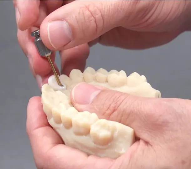 Implant concierge accuracy