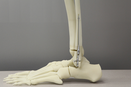 3D Printed Bone Model