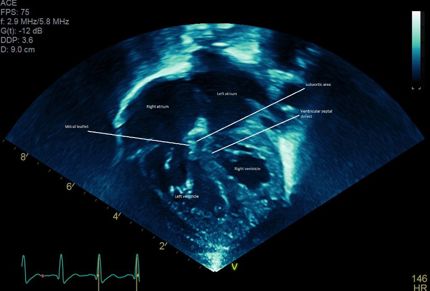 3D Printed Heart Model Helps Cardinal Glennon Children’s Hospital Plan Complex Surgeries