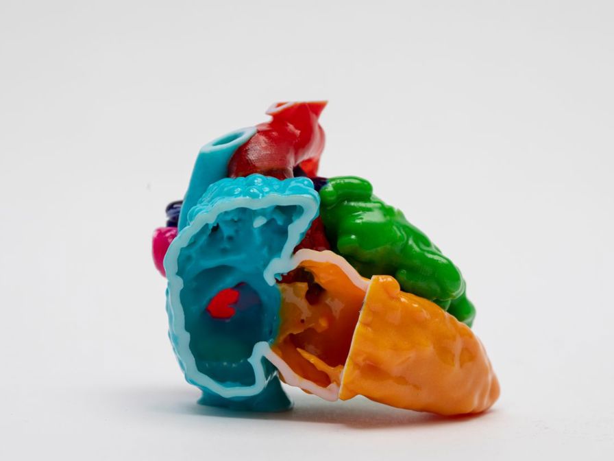  3D model of the heart of a 5-day-old infant with congenitally corrected transposition of the great arteries with a large ventricular
septal defect and severe subaortic stenosis. (AO – aorta, ASD – atrial septal defect, RA – right atrium, LV – left ventricle, MV – mitral valve,
VSD – ventricular septal defect)