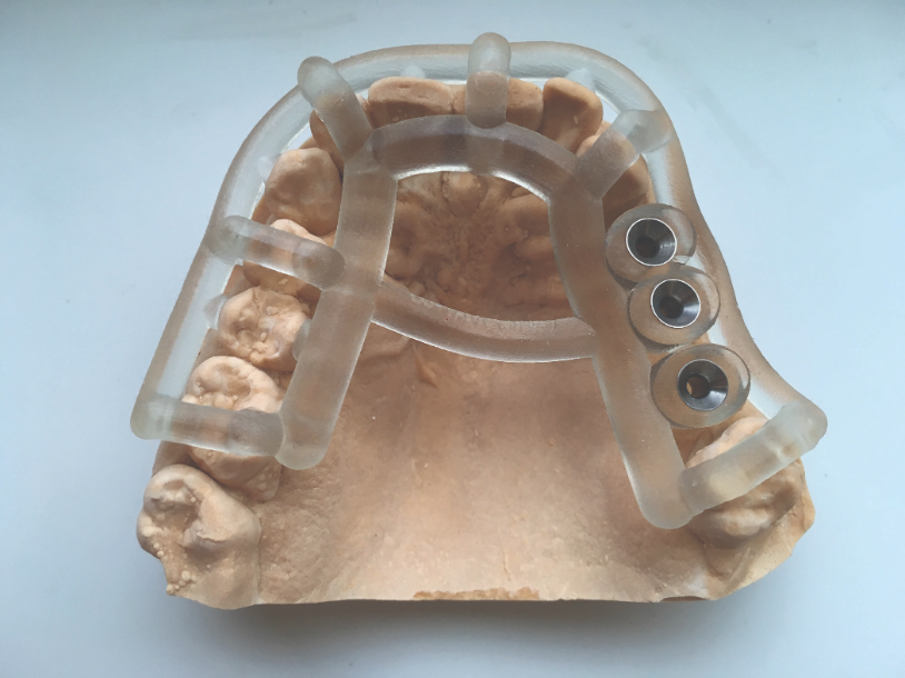 A 3D printed surgical guide mounted on a replica of a patient’s jaw.