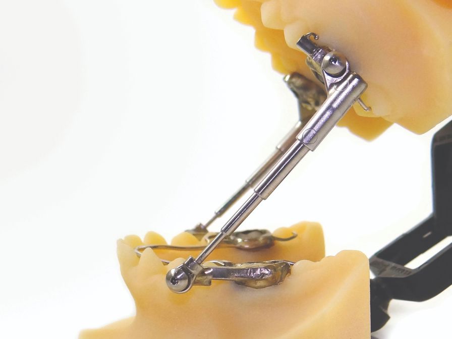 Specialty Appliances says 3D printing is faster and more accurate when creating models like this Herbst appliance.