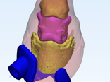 keratoma fix CAD model