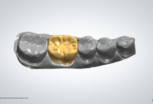 3d printing dental implants