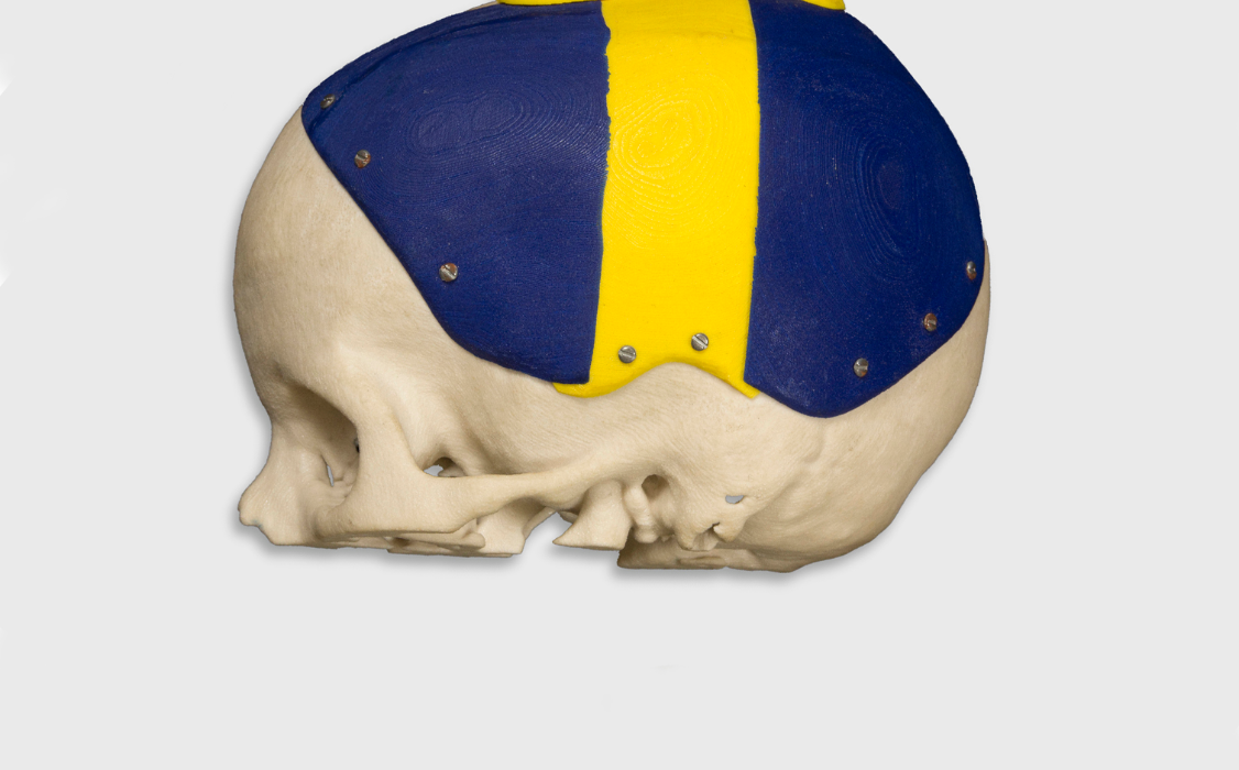 Renato Archer’s Information Technology Center helped create cranial prostheses for a 12-year-old car accident victim. The center designed a skull to adjust to the child’s growth, year after year.