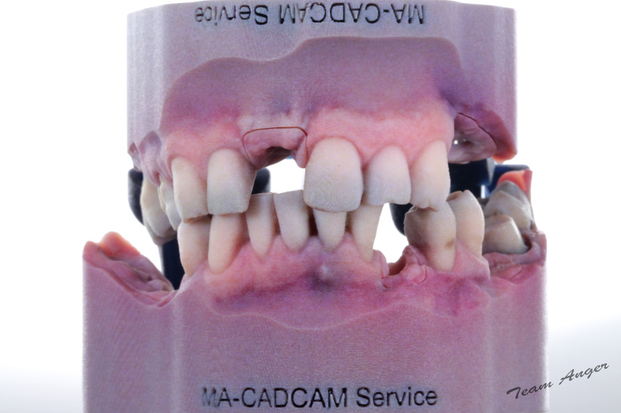 dental model printed with j5 dentajet