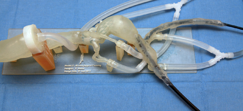 Planning complex endovascular AAA procedures with 3D printed models