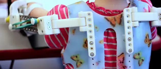 Child wearing a butterfly-patterned medical brace with adjustable 3D printed components, shown in a hospital or clinical setting.