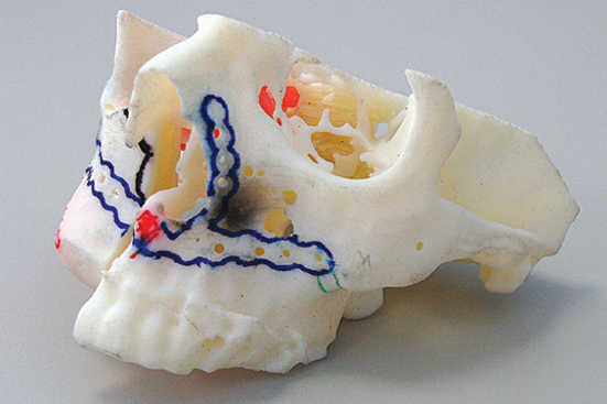 3D printed skull model with surgical planning marks and implant guide