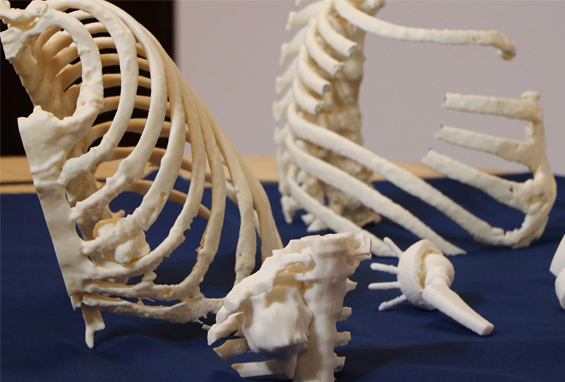 Collection of 3D printed ribcage and spine models for surgical planning